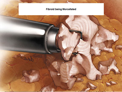 Risk of Myomectomy