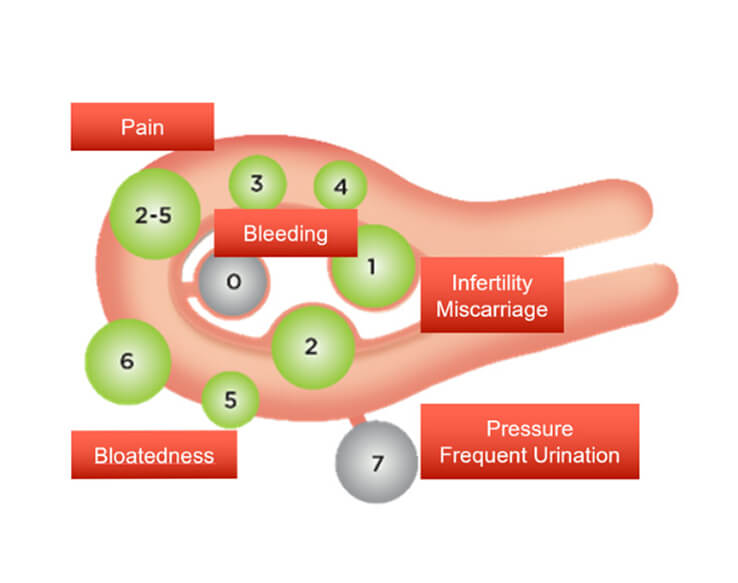 Fibroid Symptoms & Treatment