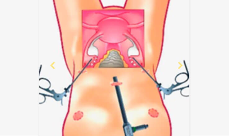 Laparoscopic Myomectomy