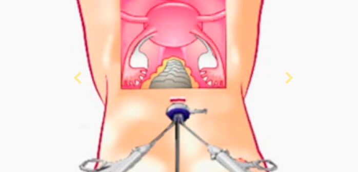 Single Incision Laparoscopic Myomectomy
